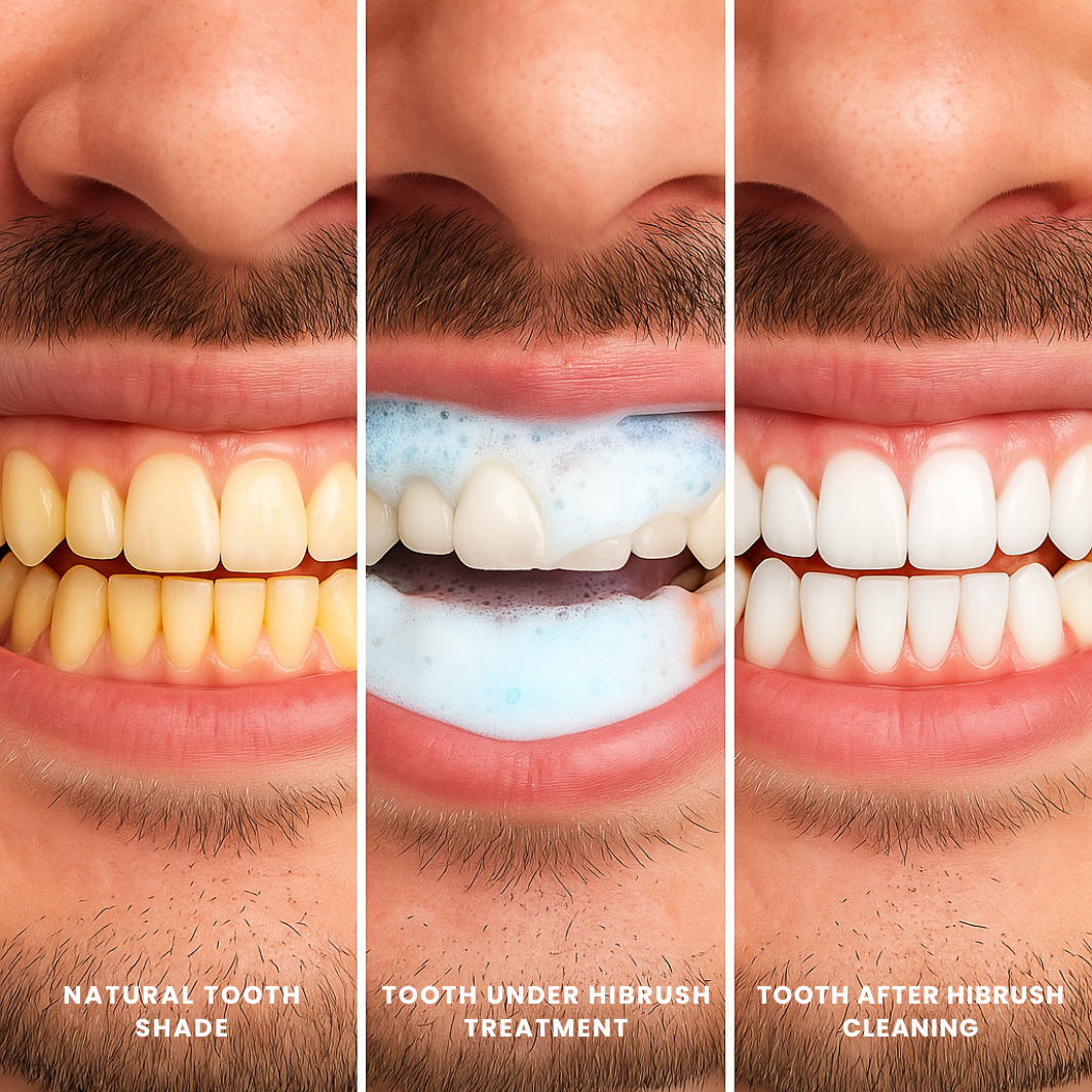 PrecisionFit™ Mouthpiece